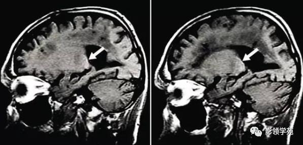 头部t1wi信号不均匀增高,脑t1wi和t2wi稍低信号