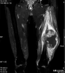 菁讲:你所不知道的横纹肌肉瘤