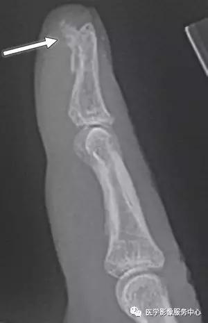 手腕撕脱性骨折一年了还隐隐作痛,手腕三角骨撕脱骨折症状有哪些