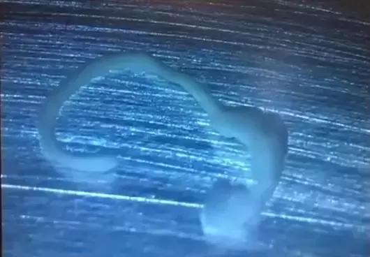 女孩脑中的寄生虫,20岁女孩脑袋有寄生虫后续