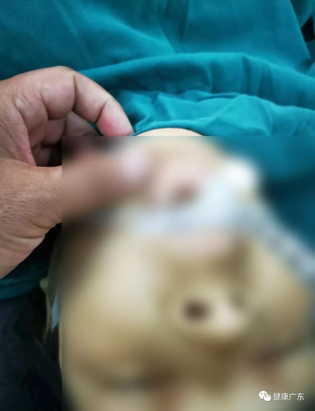 纪实|维族妈妈命悬一线广东医生东方来