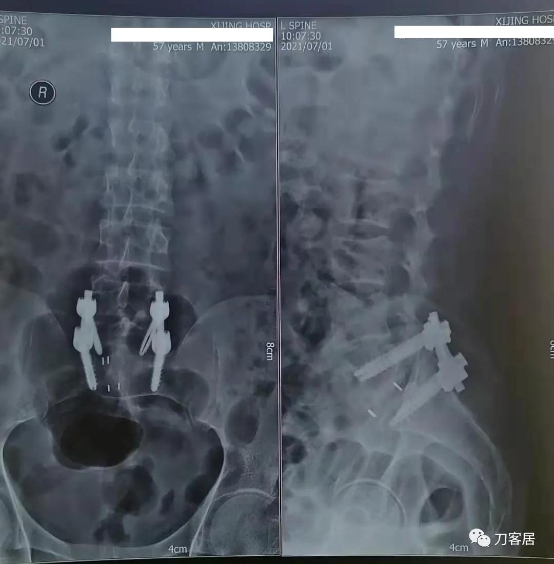 小针刀扎到坐骨神经会瘫痪吗,小针刀会切断坐骨神经吗