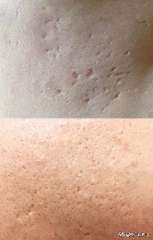 脸上小痘坑怎么修复,痘坑到底能不能修复