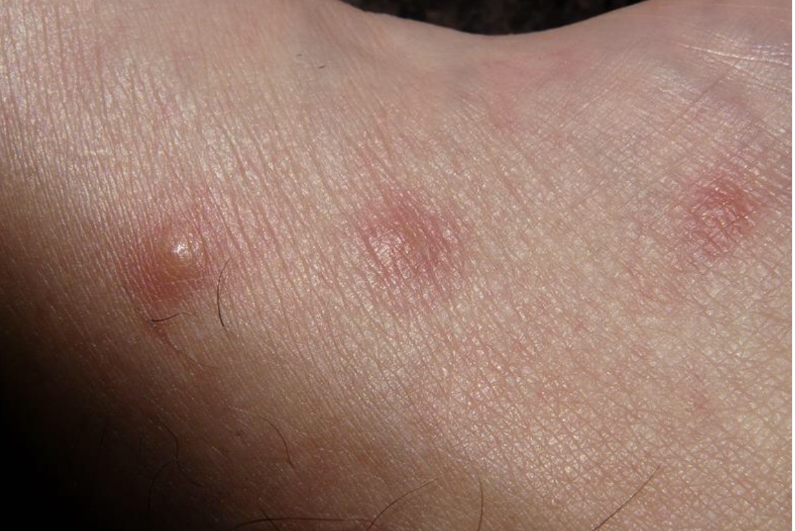 宝宝湿疹皮炎怎么治,宝宝湿疹脂溢性皮炎