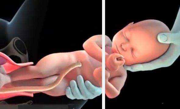 宝宝顺产出生的过程,剖腹产的小孩比顺产的小孩胆小吗