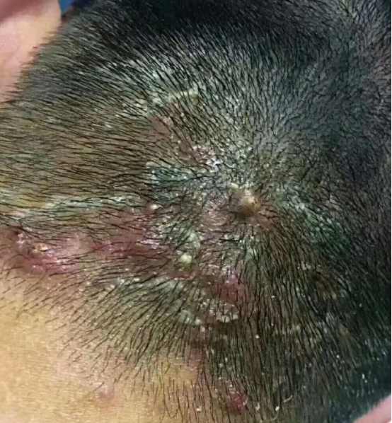 毛囊炎的治疗方法反反复复,毛囊炎反反复复怎么能治好