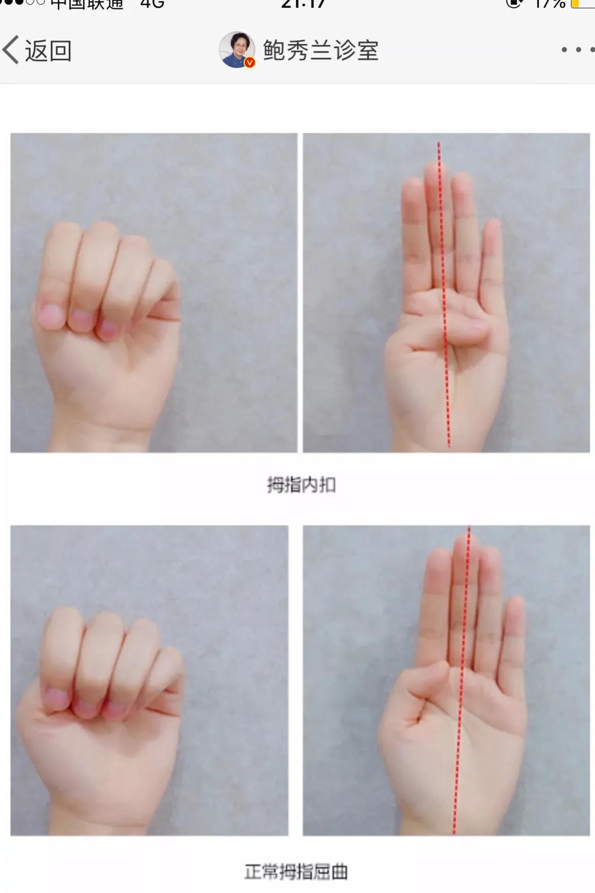 宝宝的手大拇指内弯,宝宝的拇指都是向着掌心的吗