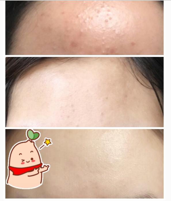 消灭闭口粉刺正确护肤方法,闭口性粉刺可以补水护肤吗