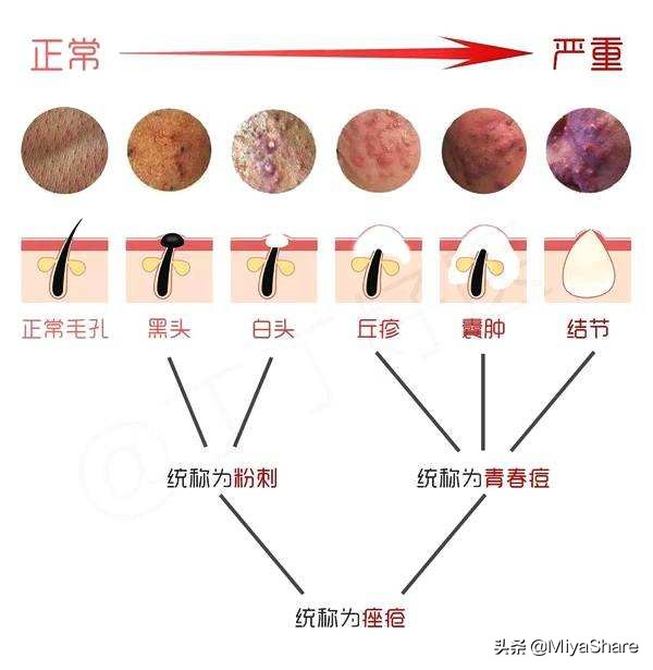 去黑头最有效的是泥膜还是鼻贴,去黑头闭口最简单的方法