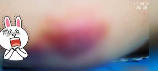 女子面部整形后差点丧命,女子做了一个可怕的整形手术