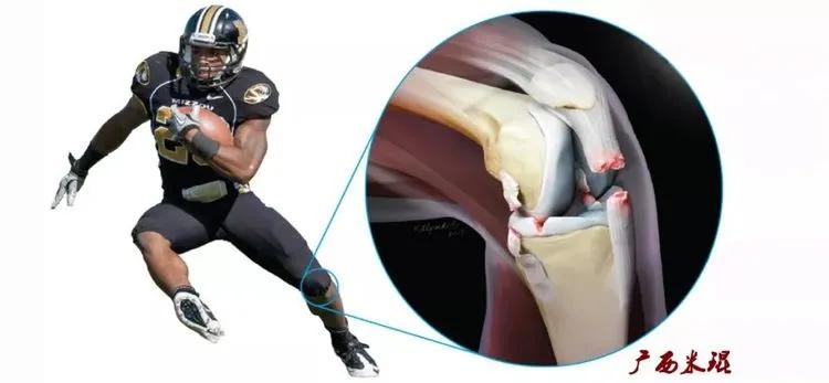 前交叉韧带扭伤最快自愈方法,前交叉韧带损伤膝关节会疼吗