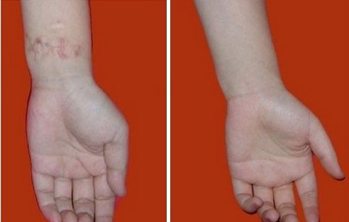 烧伤烫伤自救,烧伤后应急措施