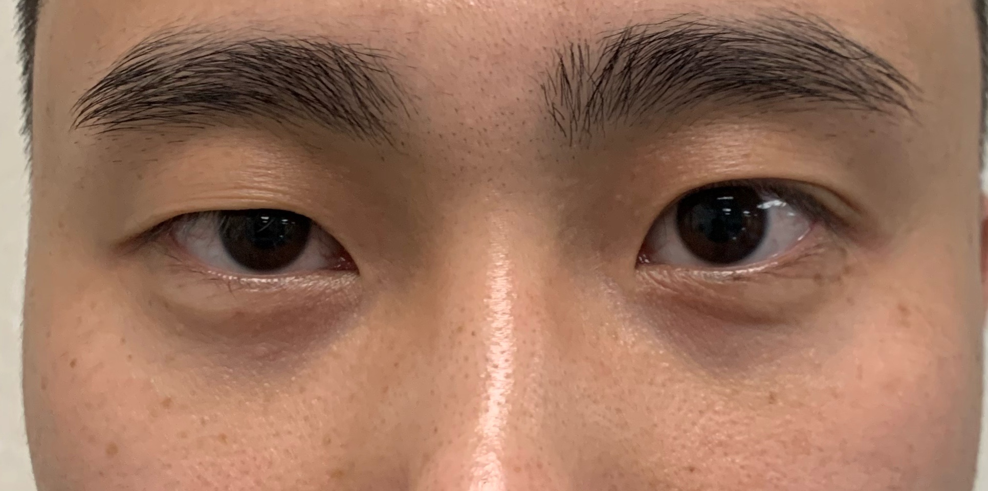 单眼皮怎么贴出平行双眼皮,单双眼皮现实中好看吗