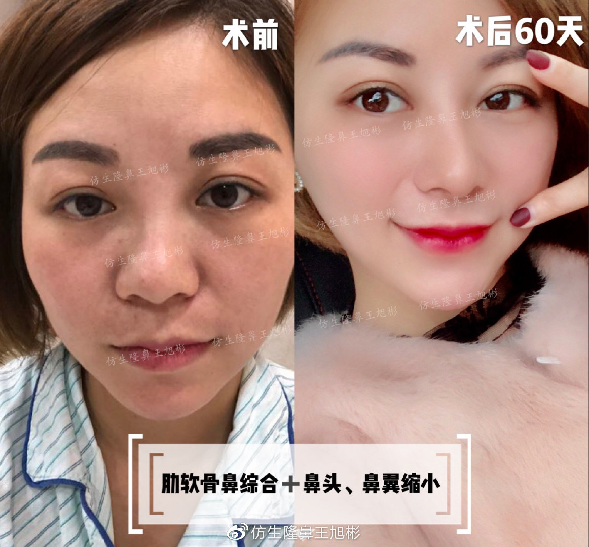 大宽朝天鼻整形过程,窄鼻子如何通过鼻整形来矫正