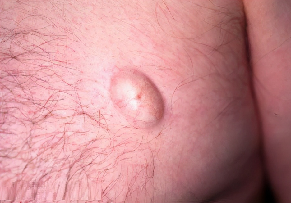 枕部表皮囊肿是怎么回事,表皮囊肿是如何形成的呢