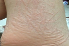 人工性*麻疹荨**是怎么造成的？很严重吗？