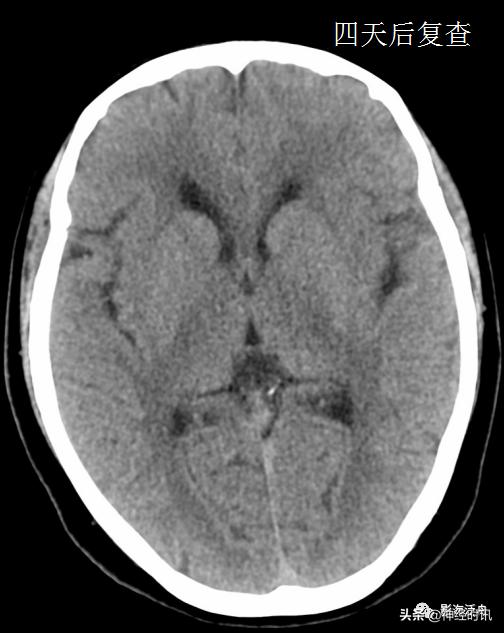 蛛血的临床表现,蛛血ct表现