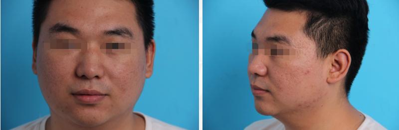 祛疤痕实拍,祛疤痕误区