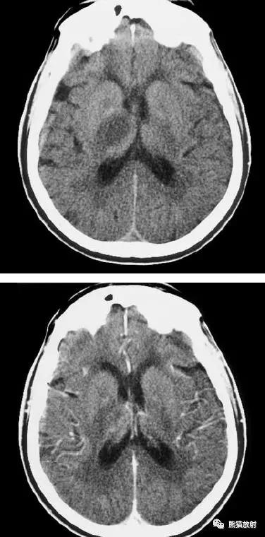 各部位脑梗死ct影像讲解,脑梗死ct影像最简单的是什么表现