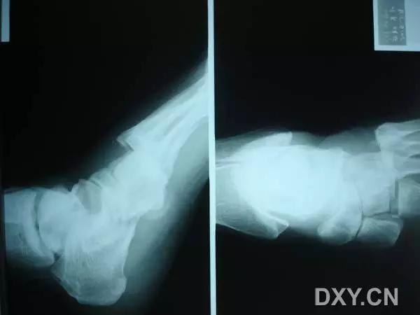 所有骨折都叫什么名字,骨折的名称有哪些