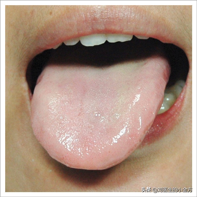 中医舌诊图解100例,中医舌诊图与舌诊口诀