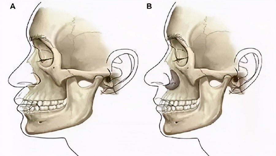 法令纹是什么怎么改善,为什么会有法令纹怎样才能消除