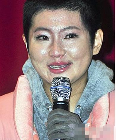 俞灏明烧伤事件真相大揭秘,俞灏明烧伤事件图片曝光