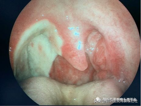 扁桃体腺样体切除后什么时间最痛,扁桃体切除后白膜脱落时更痛了