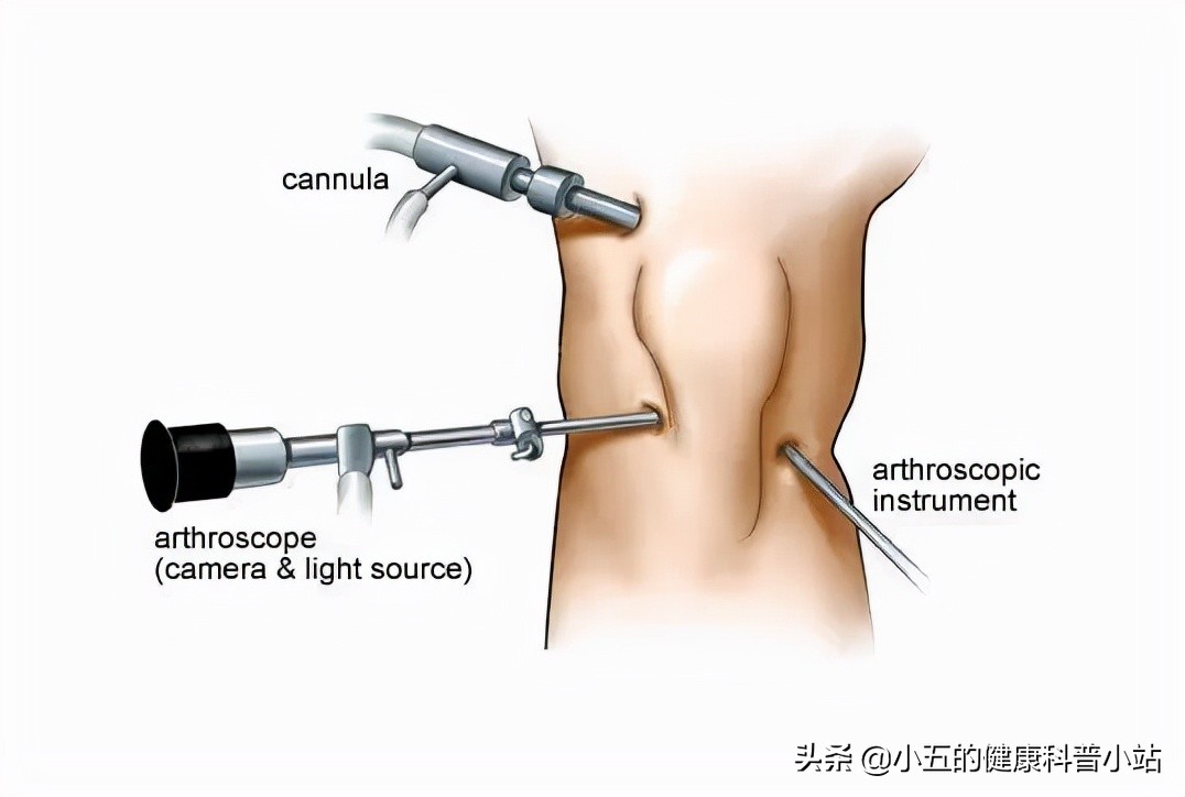 膝关节咔咔作响怎么回事,膝盖痛髌骨软化症怎么治疗