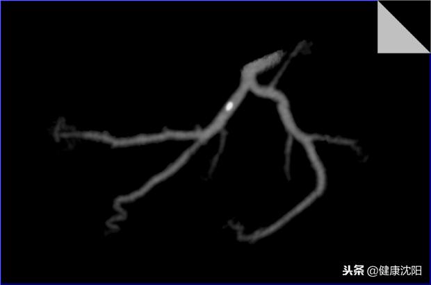 cta和血管造影怎么选择,血管oct检查与血管造影检查的区别