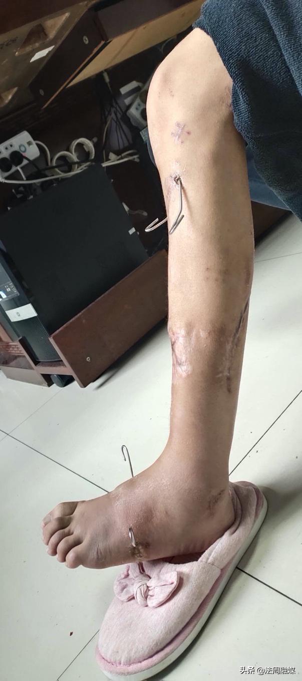 交通事故小腿胫骨骨折做手术,常德市第一中医医院骨伤科