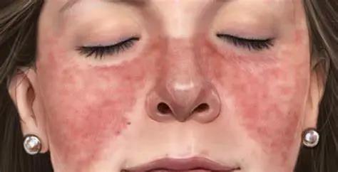 系统性红斑狼疮新药研发首批上市,系统性红斑狼疮治疗新药新进展