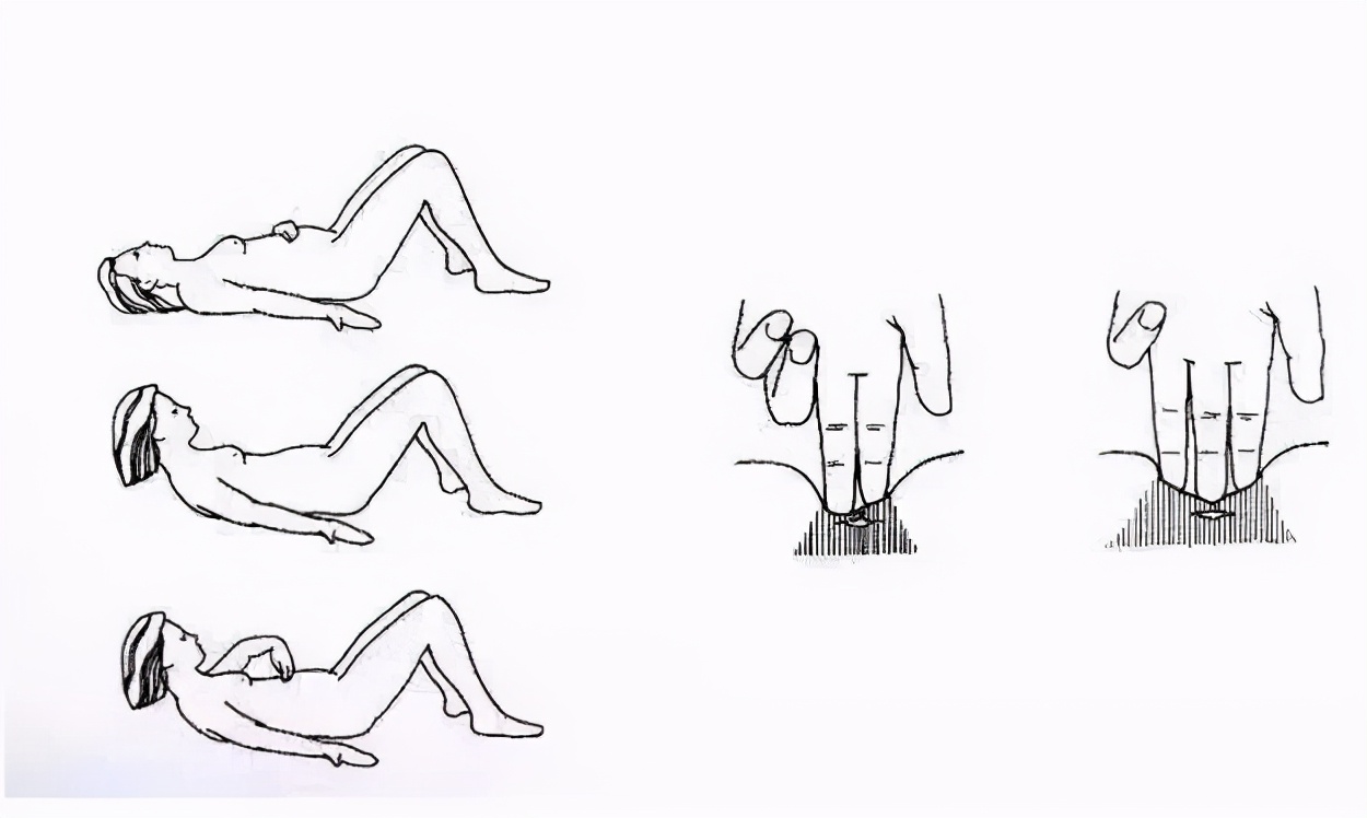 三指半到闭合，一个双胞胎妈妈的腹直肌康复之路