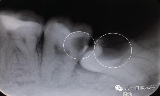 拔智齿十大危害,拔智齿利与弊