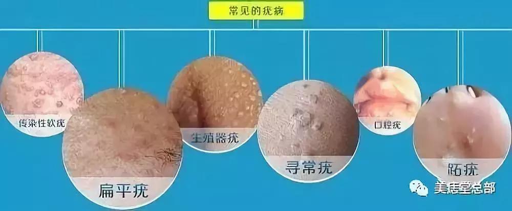 鸡眼跖疣肉刺三者之间有什么区别,跖疣鸡眼和胼胝的区别