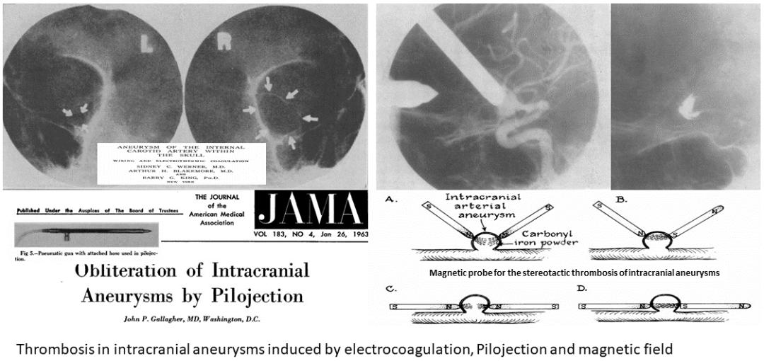 颅内动脉瘤血管栓塞治疗术后护理,颅内动脉瘤手术后血管渗血