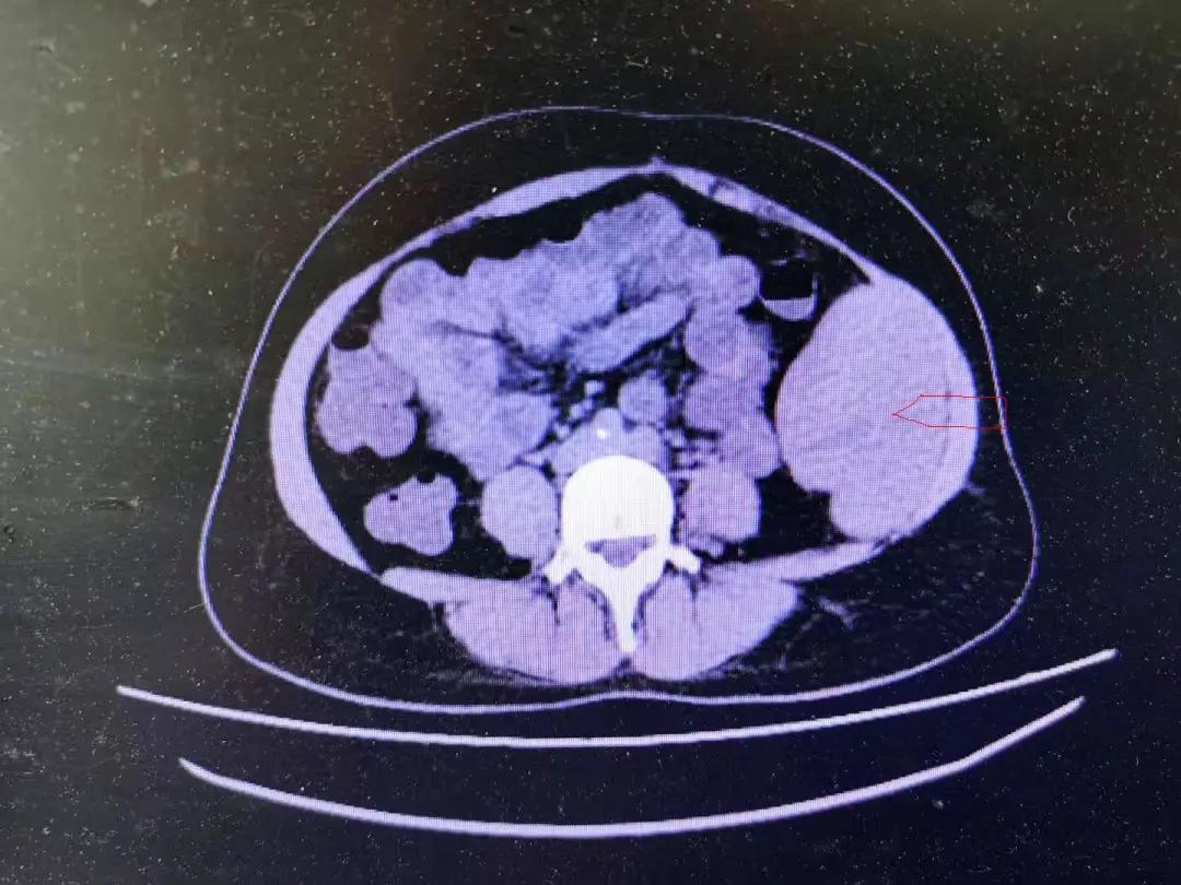 微创手术切除肠道肿瘤,中心医院切胃手术