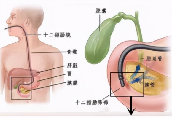 西青医院普通外科医疗团队连续运用ERCP微创技术治疗高危难病患