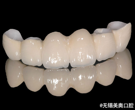 烤瓷牙和全瓷牙应该怎么选,全瓷牙和烤瓷牙会有口臭吗