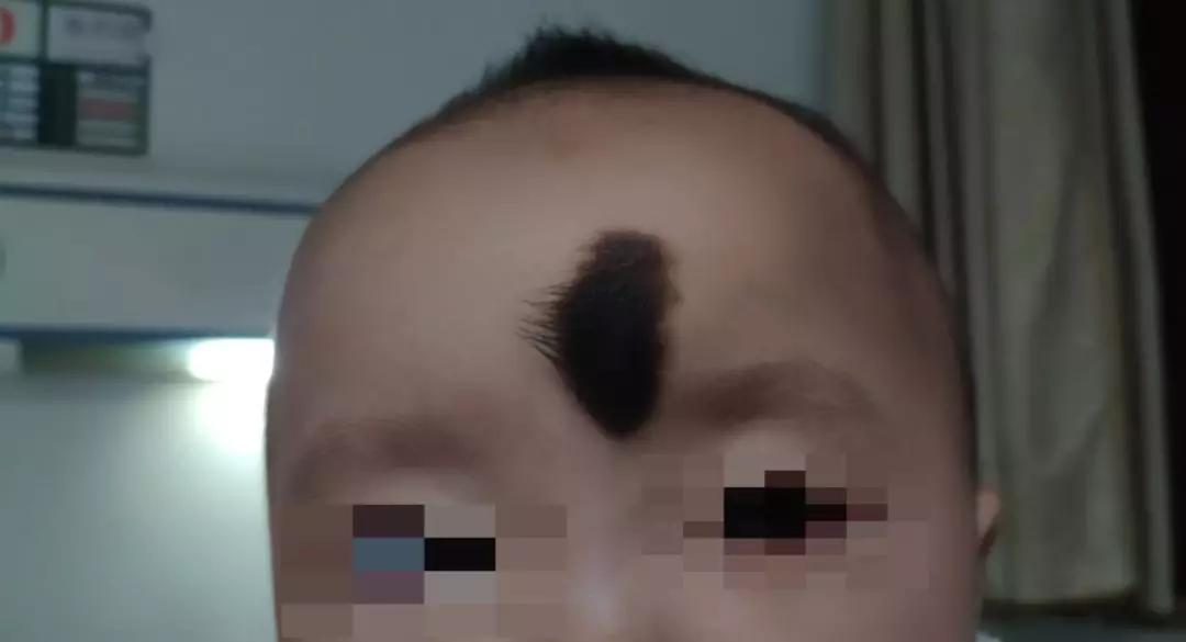 超减张缝合术哪里做的好,超减张精细缝合术如何修复疤痕