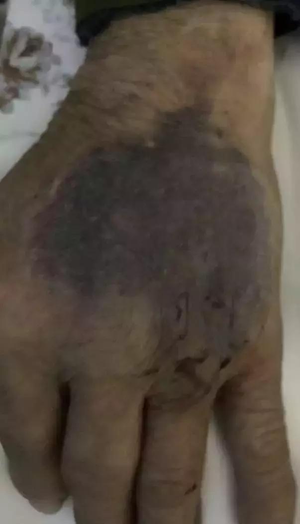 手背有淤血怎么回事,输液手背有血瘀怎么办