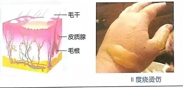 右小腿烧烫伤处理操作视频,老人烧烫伤急救处理方法