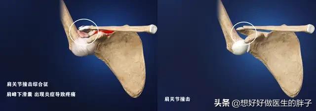 左肩疼痛是什么病的预兆,左肩疼痛要警惕什么病