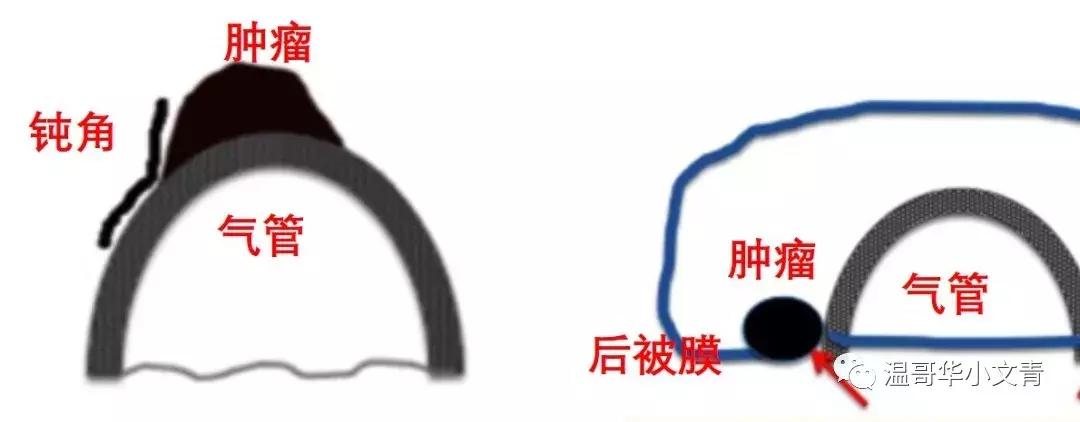 甲状腺癌治疗最好的医院,甲状腺癌的中医治疗方法