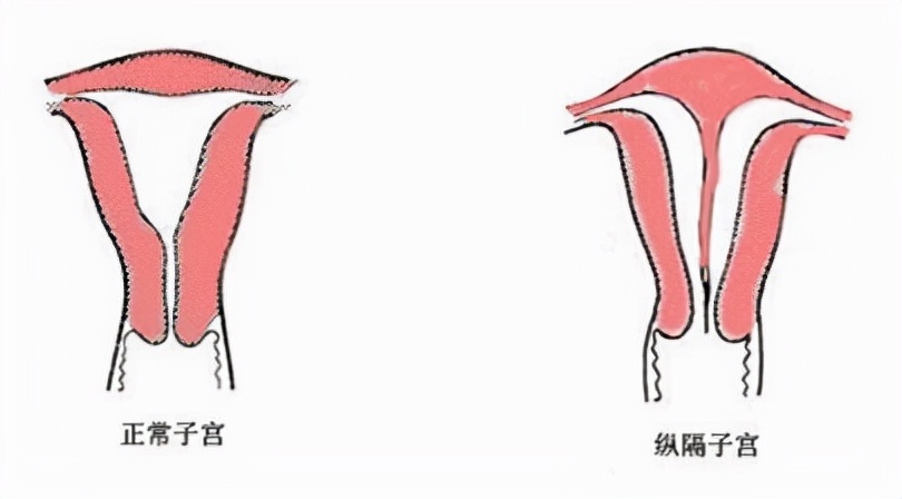 子宫疏松会影响什么,子宫多发纳囊影响受孕吗
