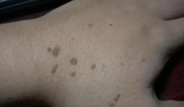 乙肝患者皮肤发黄还意味着什么,乙肝患者皮肤出现红点