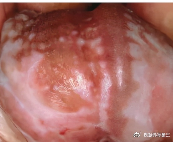 好奇,这个皮肤病居然会逐步阻挡羞羞之路