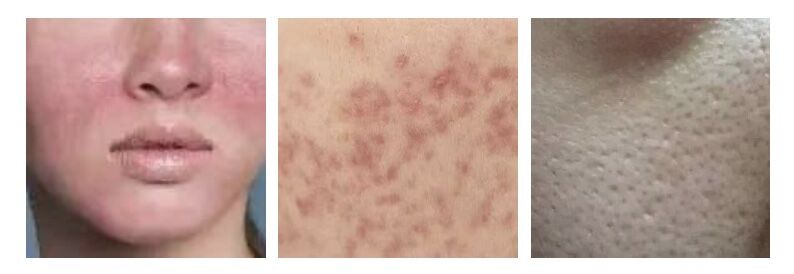 追求素颜肌必做项目之光子嫩肤——做之前需要知道的那些事