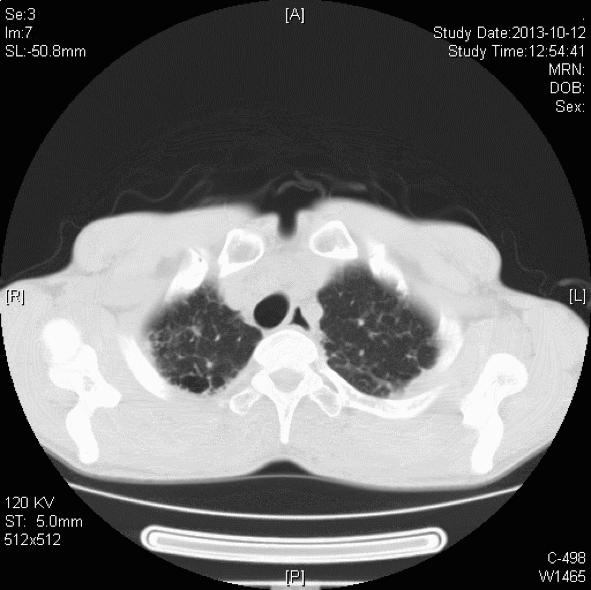 肺纤维化病例,肺纤维化手指甲发紫还能活多久