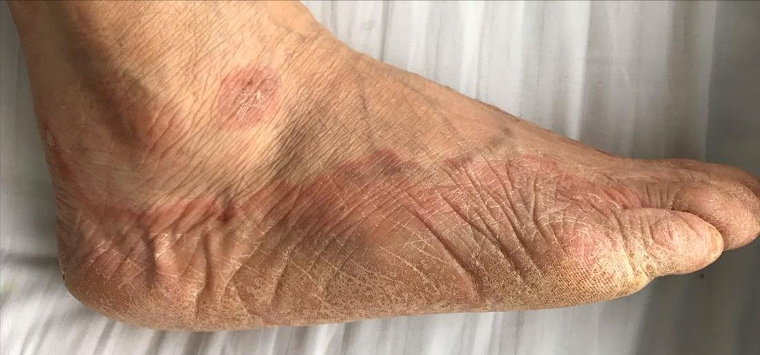 手脚瘙痒干裂，是湿疹还是手足癣？2个大相径庭的治疗方法